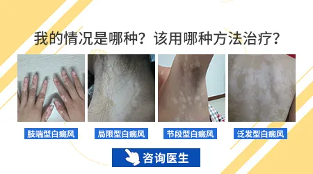肢端型白癜风初期能治愈