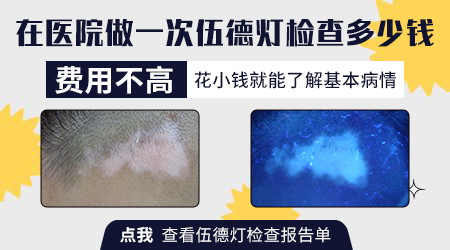 白癜风做伍德灯检查要花多少钱