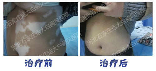 uvb光疗仪治疗白癜风的效果图