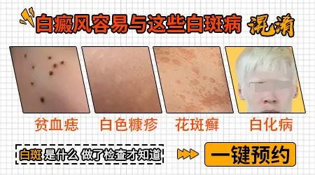 白癜风初期有哪些明显症状与其他白斑不同