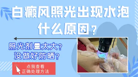 白癜风光疗后出现水疱是正常现象吗