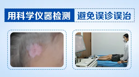 无花果叶子擦白癜风是偏方吗