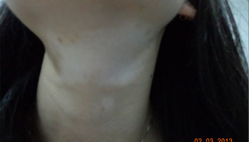 脖子白斑很光滑有扩散的症状怎么回事