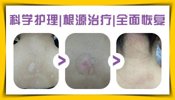 患上白癜风可以手术切除吗