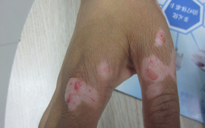 女性左手手指关节处皮肤发白的图片