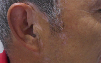 特发性点状白斑高清图