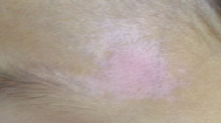 白癜风早期症状特点有哪些