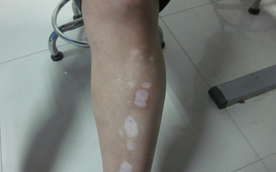 腿上长了小圆白点咋回事