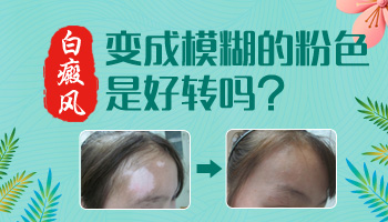 用药后白斑边缘变模糊原因