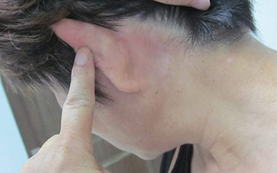 白癜风的白斑除了皮肤颜色的改变,其他和正常皮肤一样,表面非常光滑