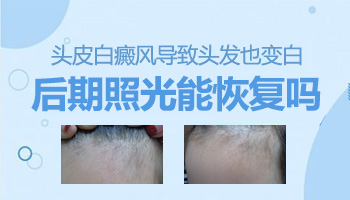 头皮有白癜风能做植皮手术吗