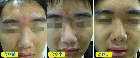 白癜风一年治愈案例