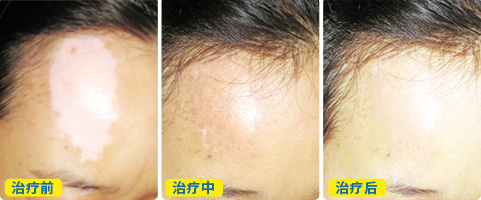 头部白癜风植皮过程图片