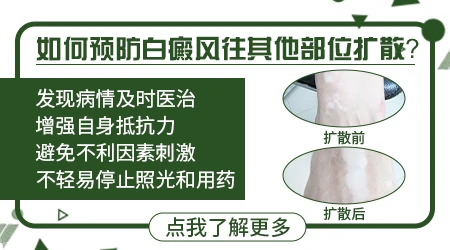 身上白点越多是不是发展的越快