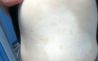 怎么算是大面积白癜风