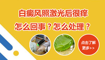 白癜风治疗期间会痒吗 白斑治疗过程