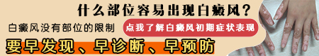 白斑初期图片 不同时期白癜风症状