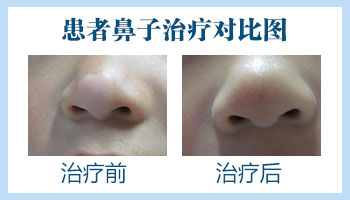 鼻翼两侧有白斑是怎么回事