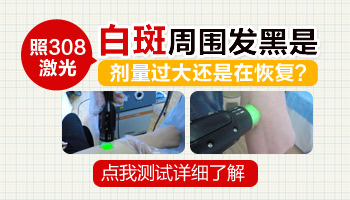 白癜风周围发黑后多久能好