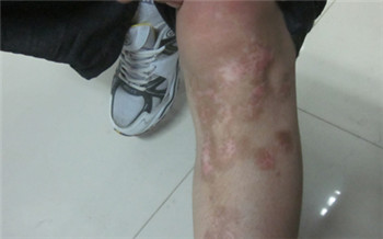 手臂上出现小白斑的图片