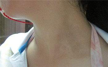 女性脖子上长白癜风的图片