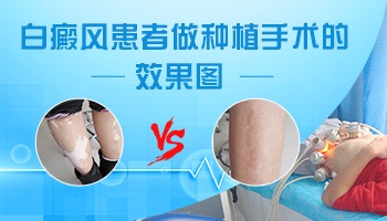 儿童白癜风黑色素种植手术的效果图片