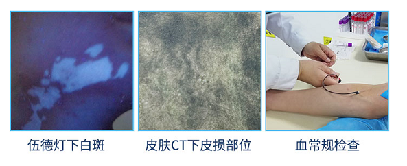 炎症后色素减退越来越白会不会是白癜风