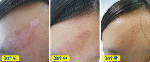 白斑有什么方法能治好吗