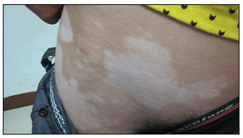 男生大腿根白癜风图片