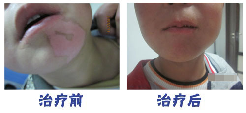 照308光疗的白斑那有点痛怎么办