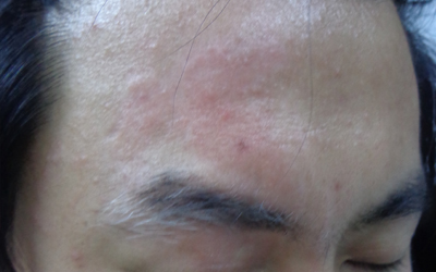 面部长白斑额头的白斑面积大了怎么回事