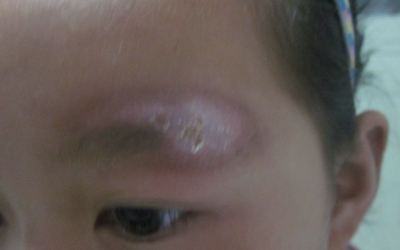 白癜风眉毛发白的图片