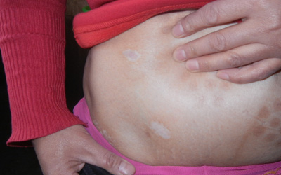 女性生完孩子肚皮上面有白斑图片