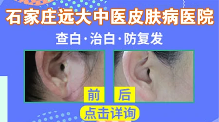 石家庄哪个医院能治反复复发的白斑