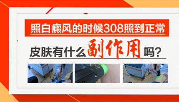 308激光对小孩白癜风有副作用吗