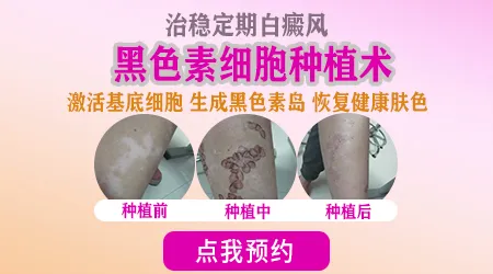 手部白癜风做黑色素种植好不好