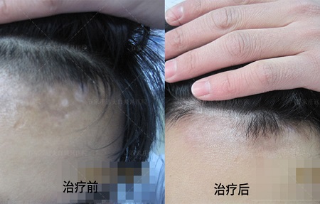 太阳穴上方发际线处一块边界清晰的白色块