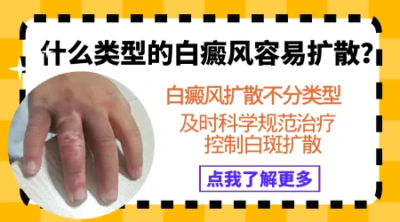 局限性白斑不会扩散吗