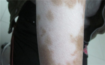 手臂白斑图片 白斑是不是白癜风怎么看