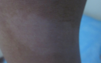 白斑长在大腿内侧瓷白色是不是白癜风