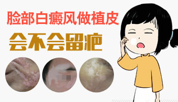 白癜风做黑色素移植会有疤痕吗