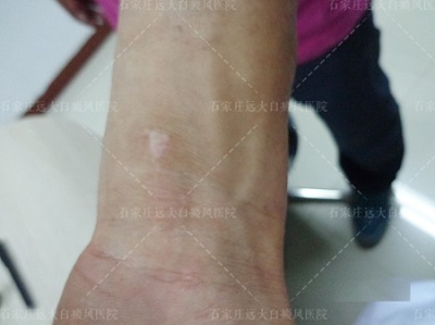 手腕上突然有一块白色的斑点是什么