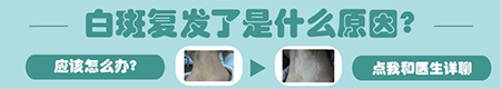 308激光治疗白斑会复发吗