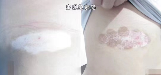 白癜风已出现色素岛以后还会扩散吗