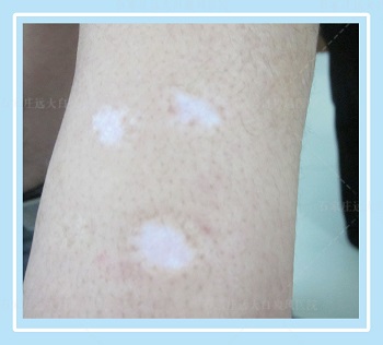 手臂上有淡白色的小白点是什么