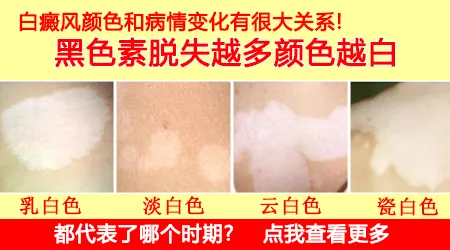 白癜风白斑有几种颜色 分别代表什么