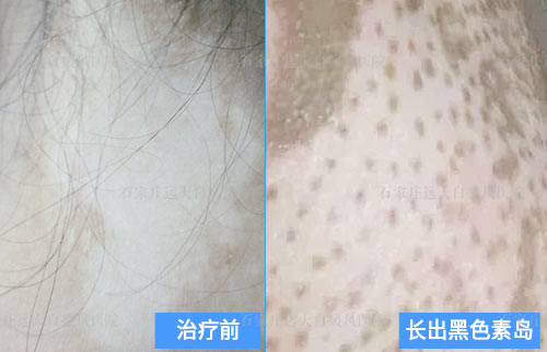 311光疗照后背白癜风越照越严重