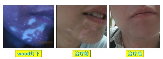 隐形白癜风怎么治
