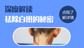 白斑怎么快速祛除 祛白斑方法