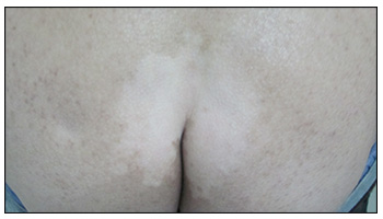 久坐老人屁股长白点是怎么回事